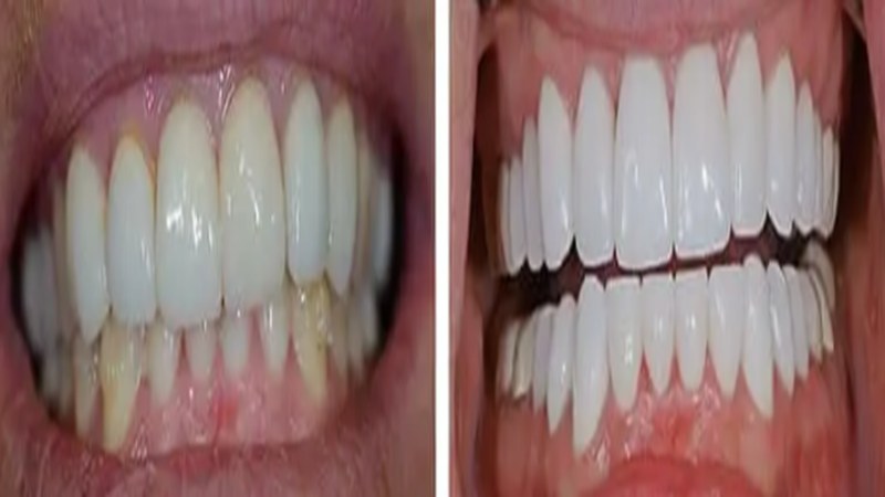 CEREC Same-Day Crowns