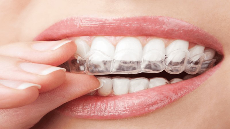 Invisalign for Teens