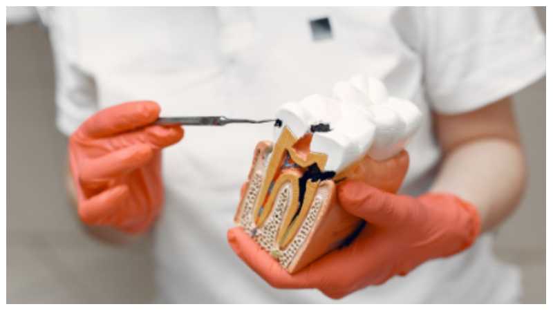 Root Canal Therapy Overview
